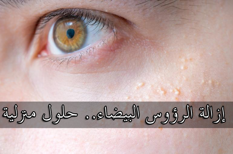 إزالة الرؤوس البيضاء.. حلول منزلية